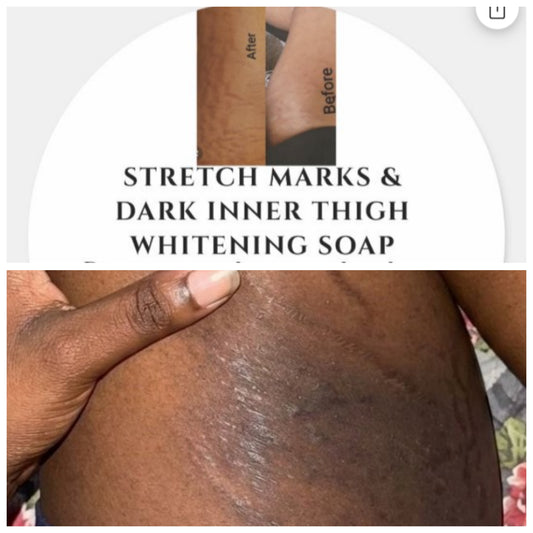 STRETCH MARKS/DARK INNER THIGH/SKIN WHITENING SOAP