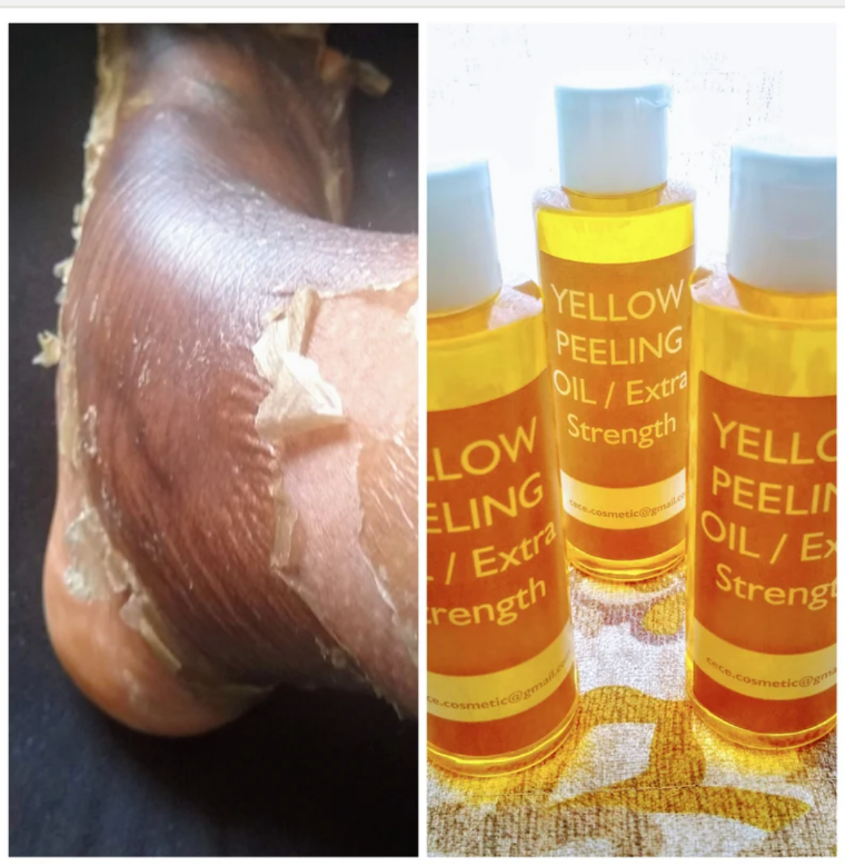 Yellow peeling oil extra strength / New Improvement